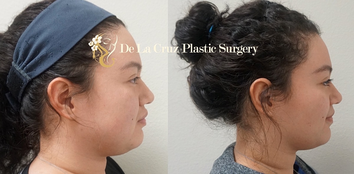 Buccal Fat Removal Before & After