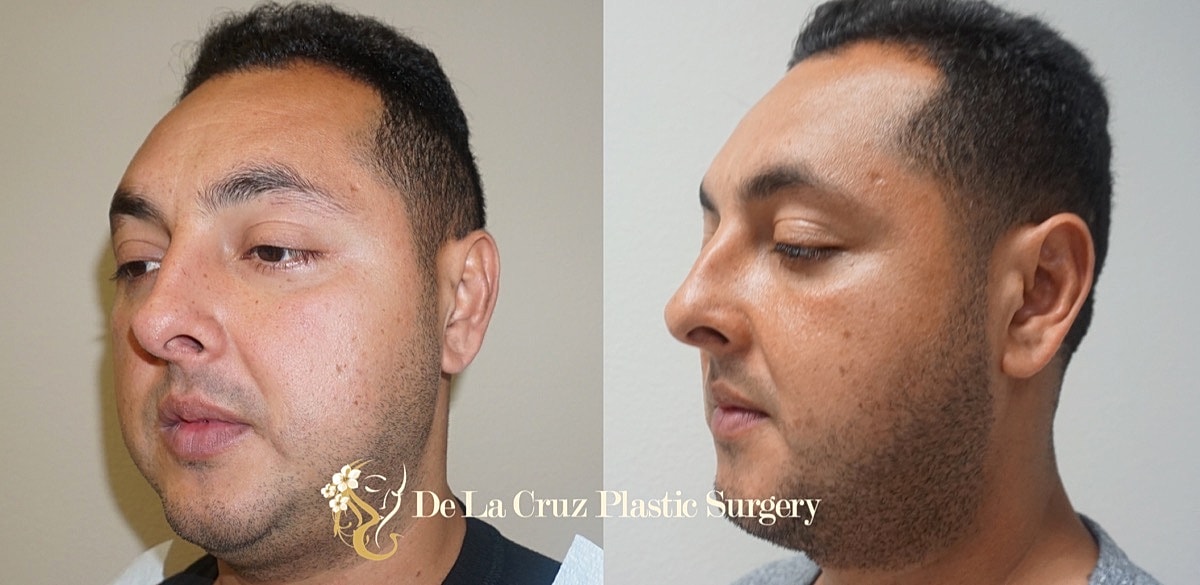 Buccal Fat Removal Before & After