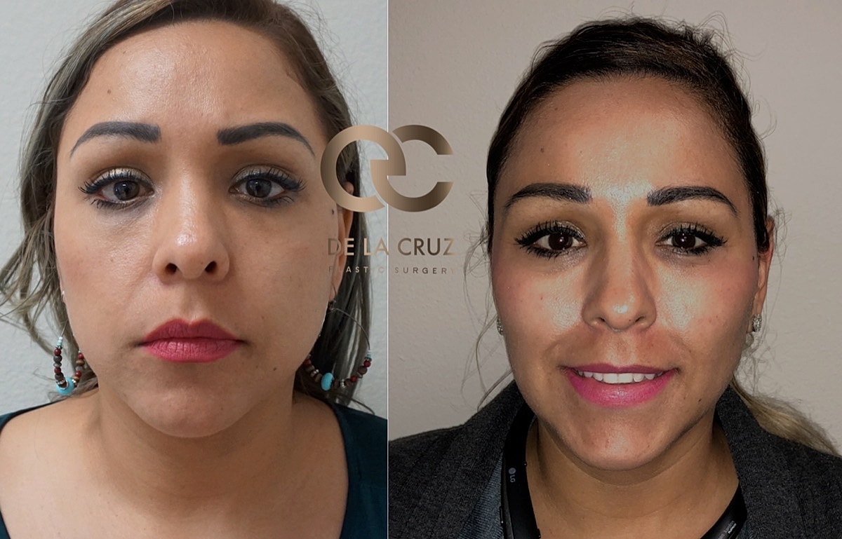 Buccal Fat Removal Before & After