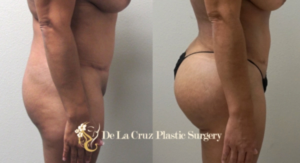 Brazilian Butt Lift Before & After
