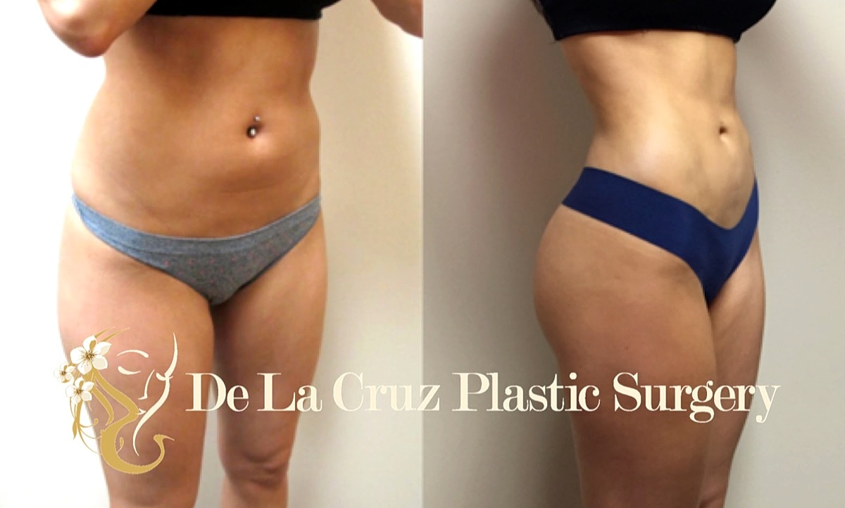Brazilian Butt Lift Before & After