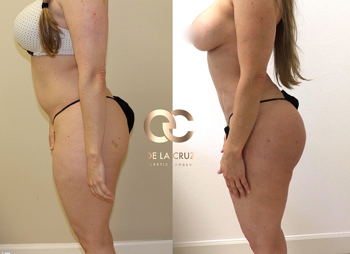 Brazilian Butt Lift Before & After
