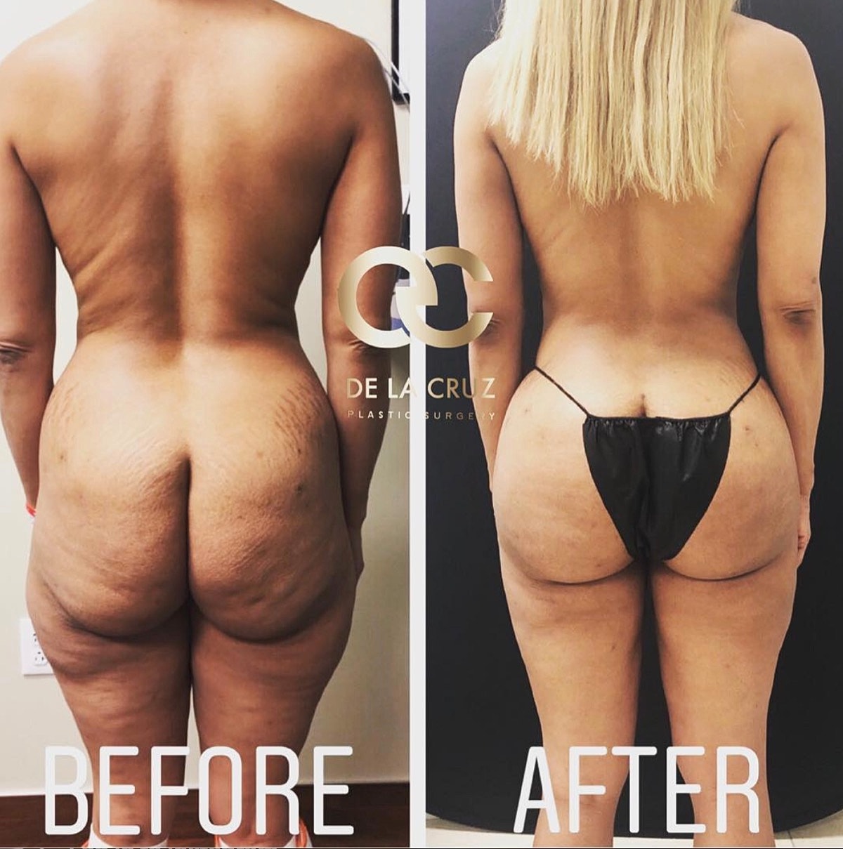Brazilian Butt Lift Before & After