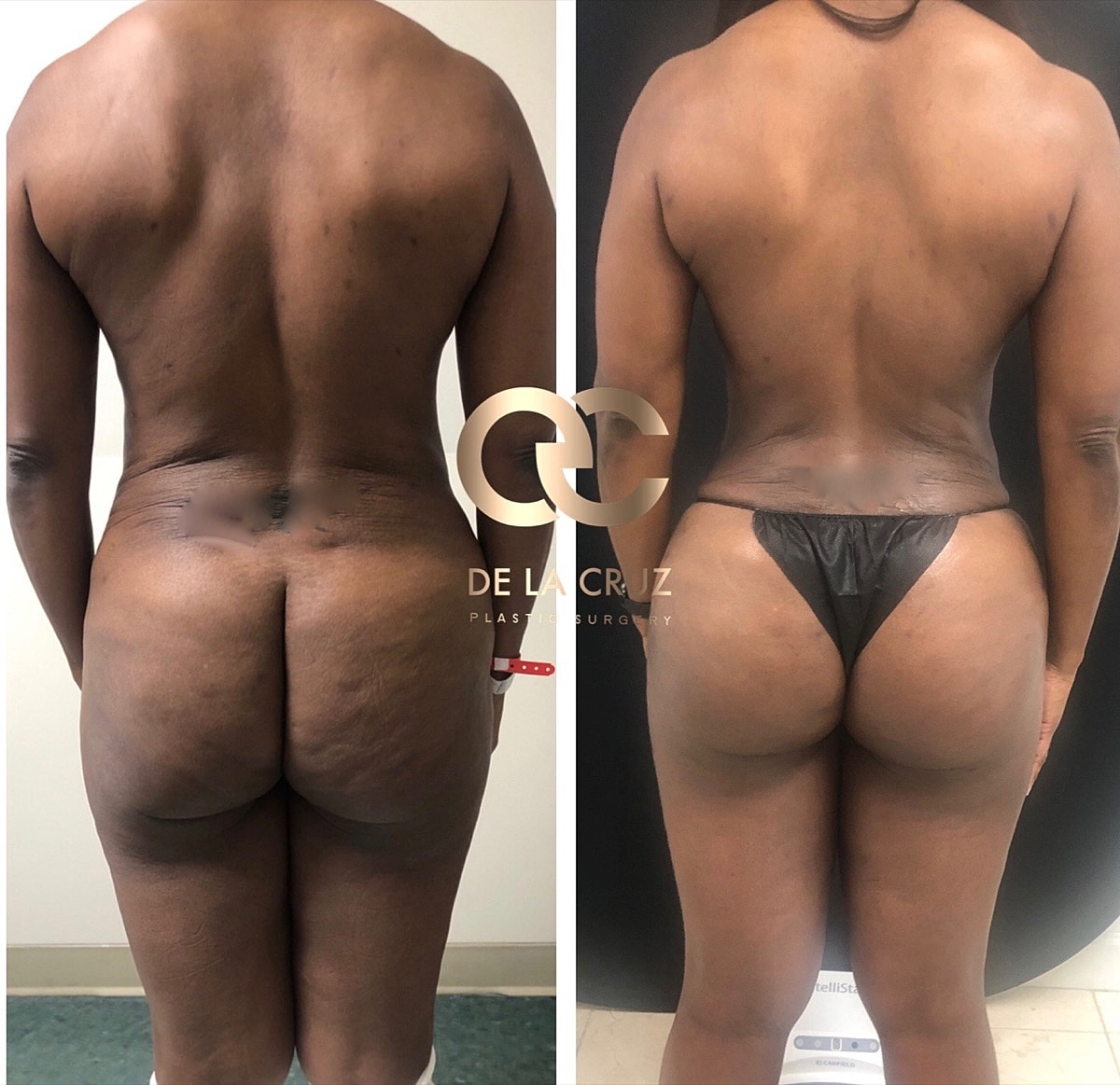 Brazilian Butt Lift Before & After