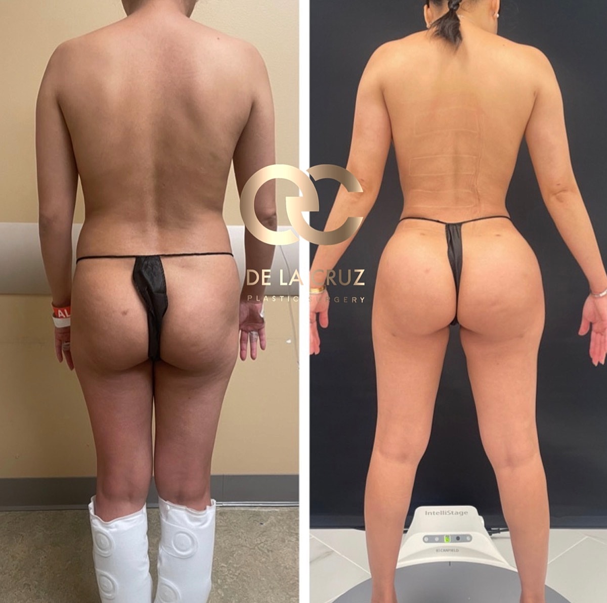 Brazilian Butt Lift Before & After