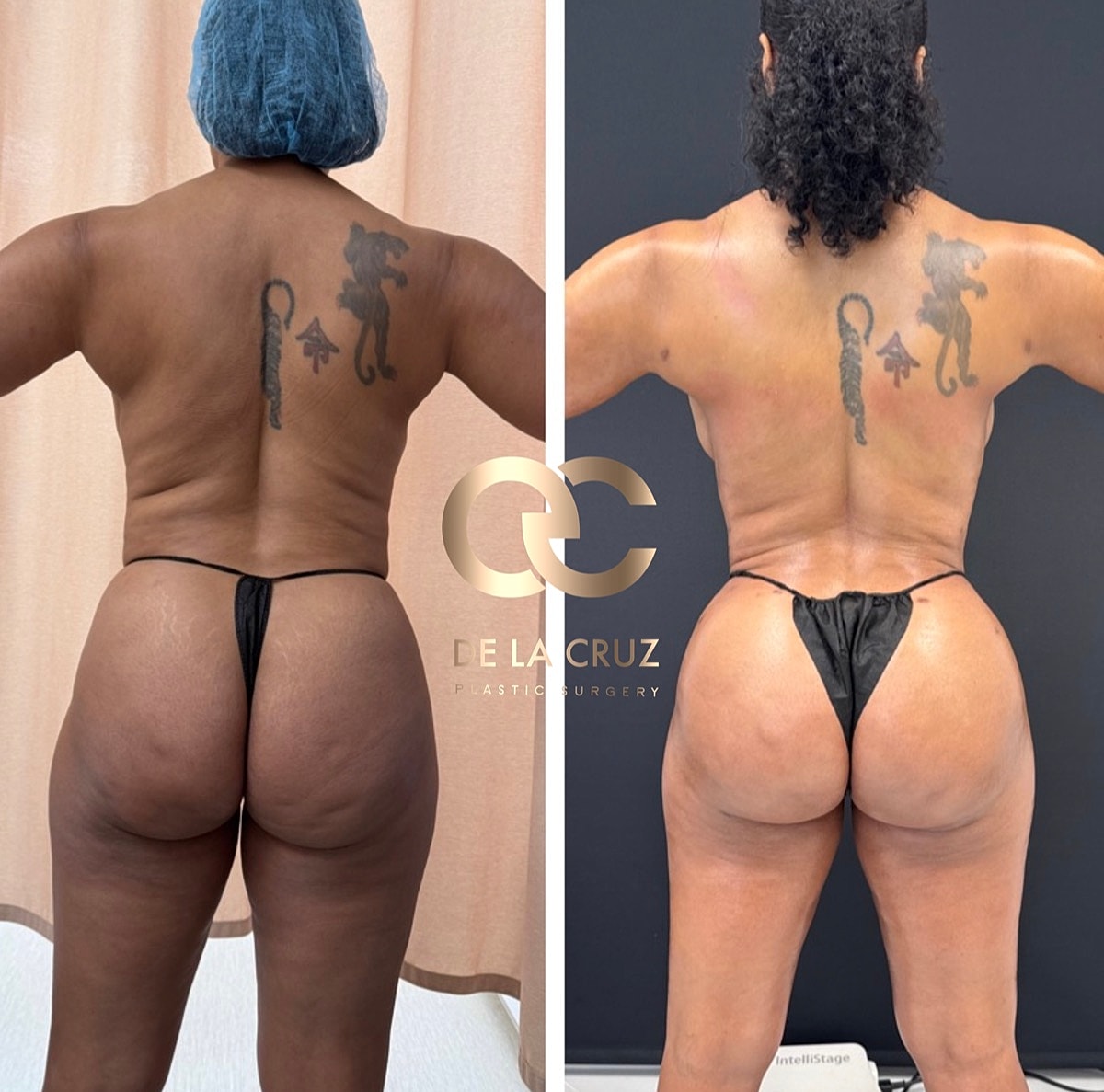 Brazilian Butt Lift Before & After