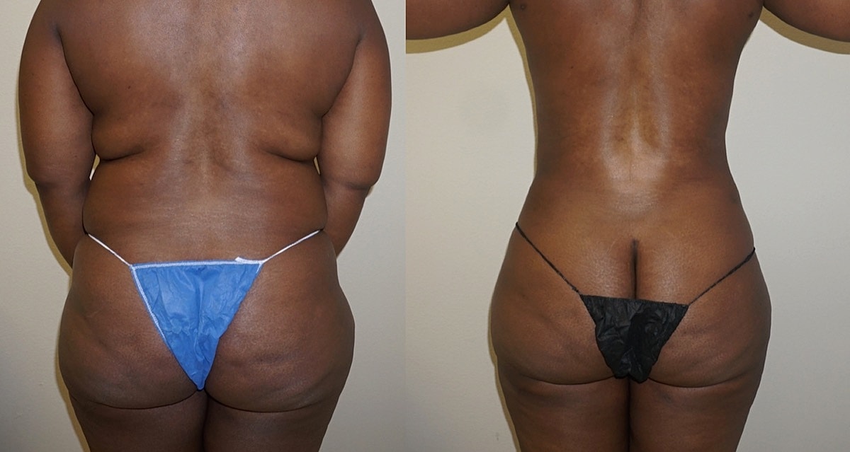 Large Volume High Def Liposuction Before & After