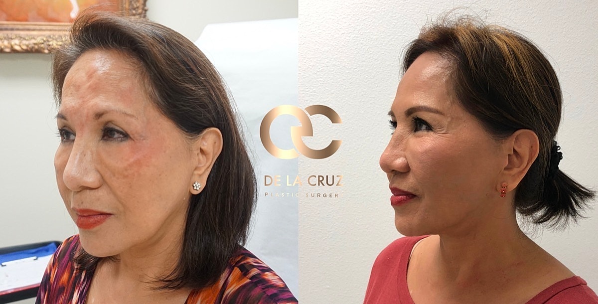 Embracerf Facetite Morpheus8 Before & After