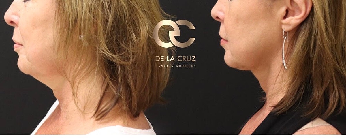 Embracerf Facetite Morpheus8 Before & After