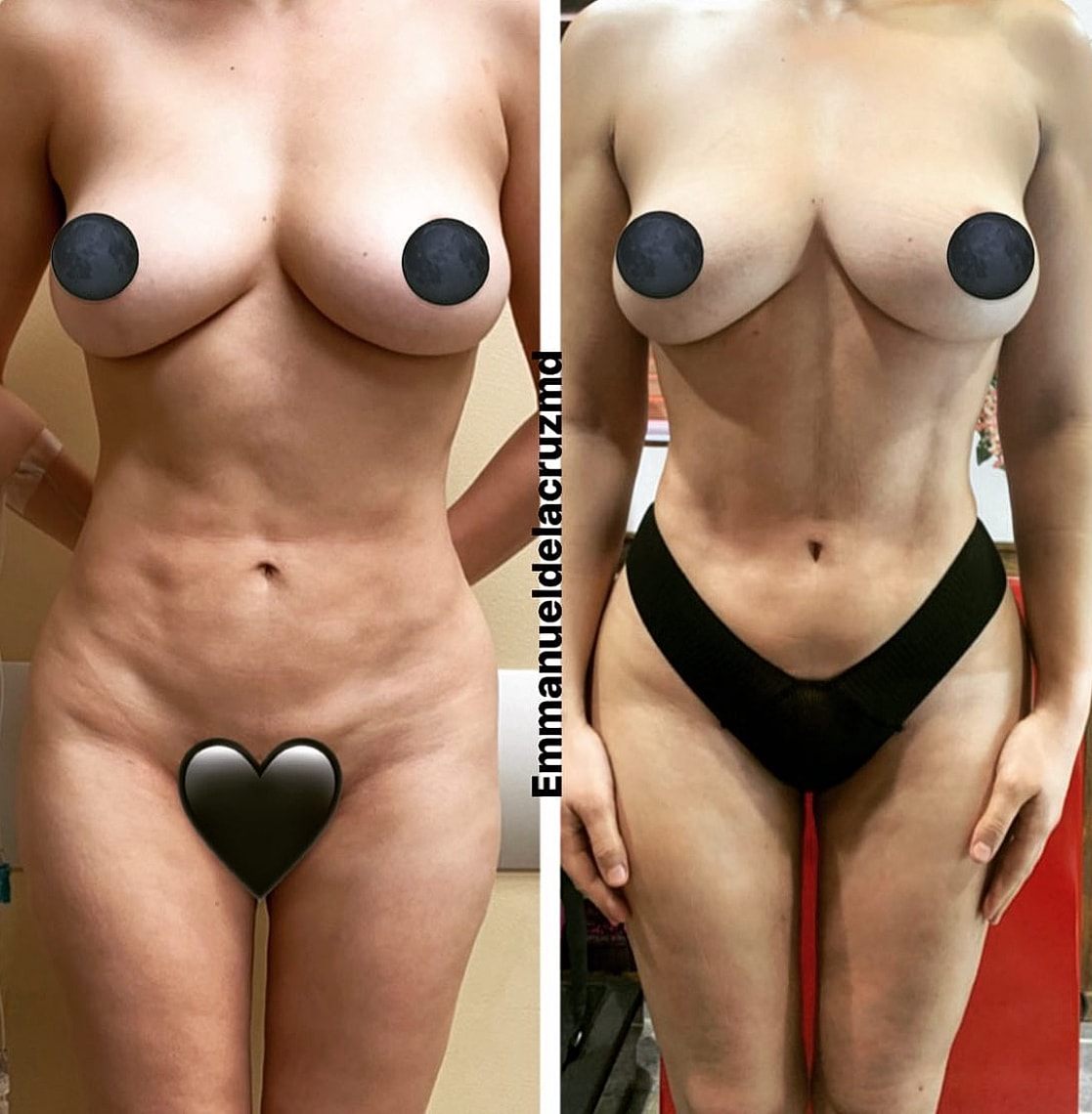revision liposuction before after Houston correction uneven liposuction results Dr De La Cruz