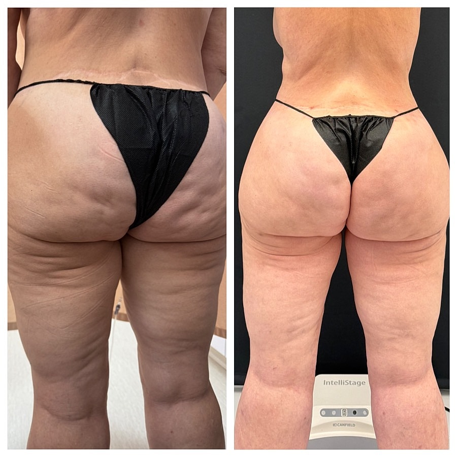 revision liposuction houston thigh contour irregularities correction vaser quantum rf morpheus8