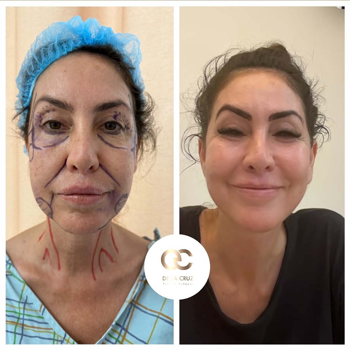 Before and after cosmetic surgery transformation.