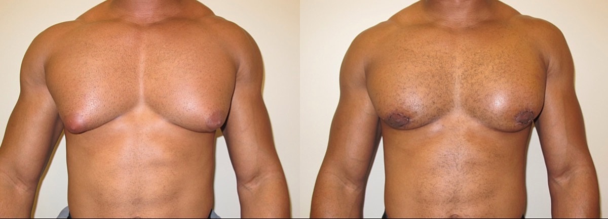 Gynecomastia Surgery Before & After