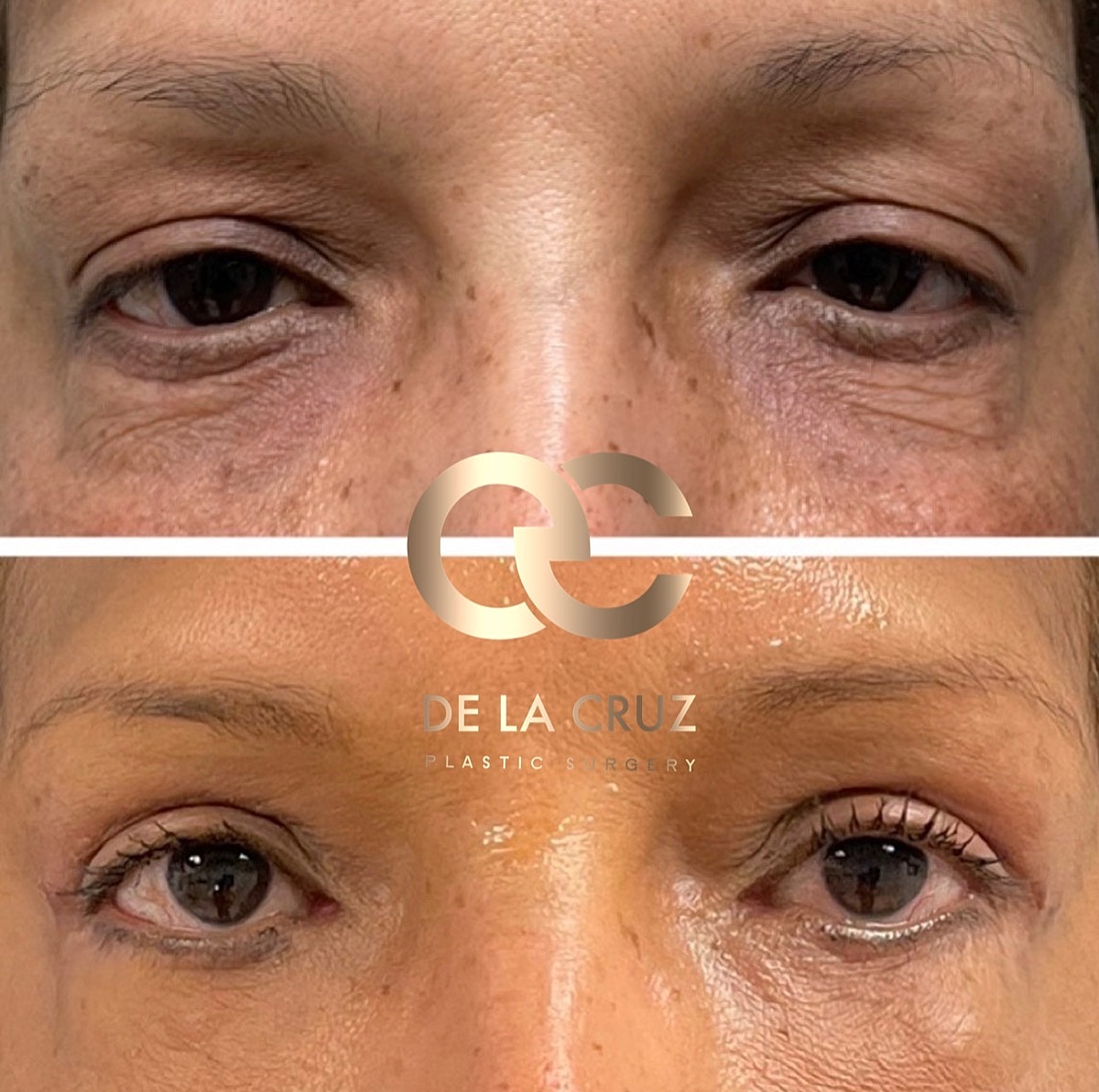 Eyelid Surgery Before & After