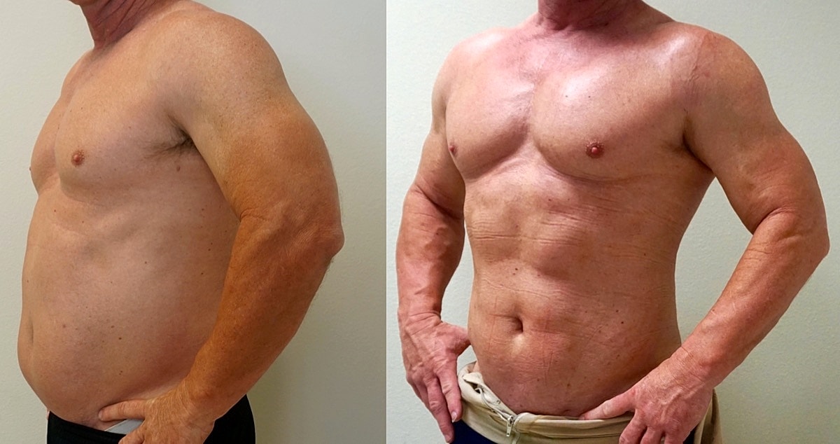4d Vaser Liposuction For Men Before & After