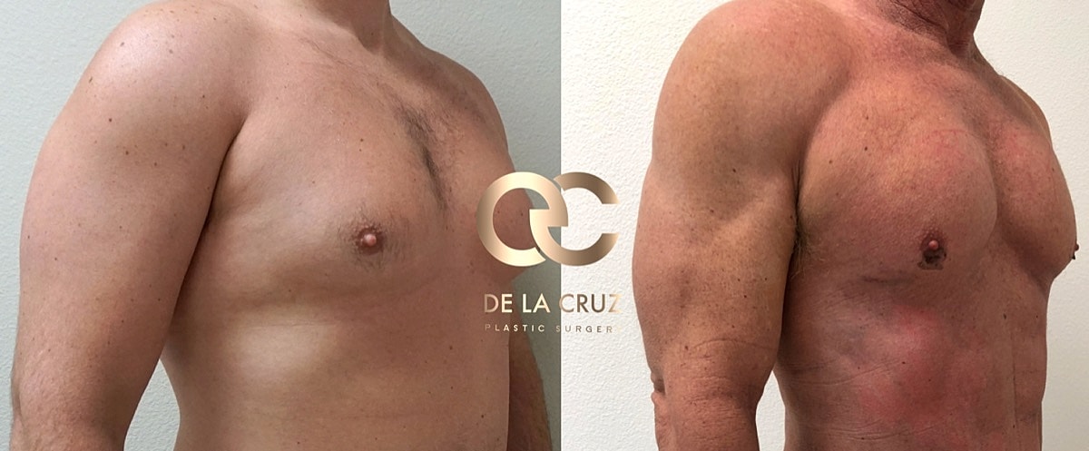 4d Vaser Liposuction For Men Before & After