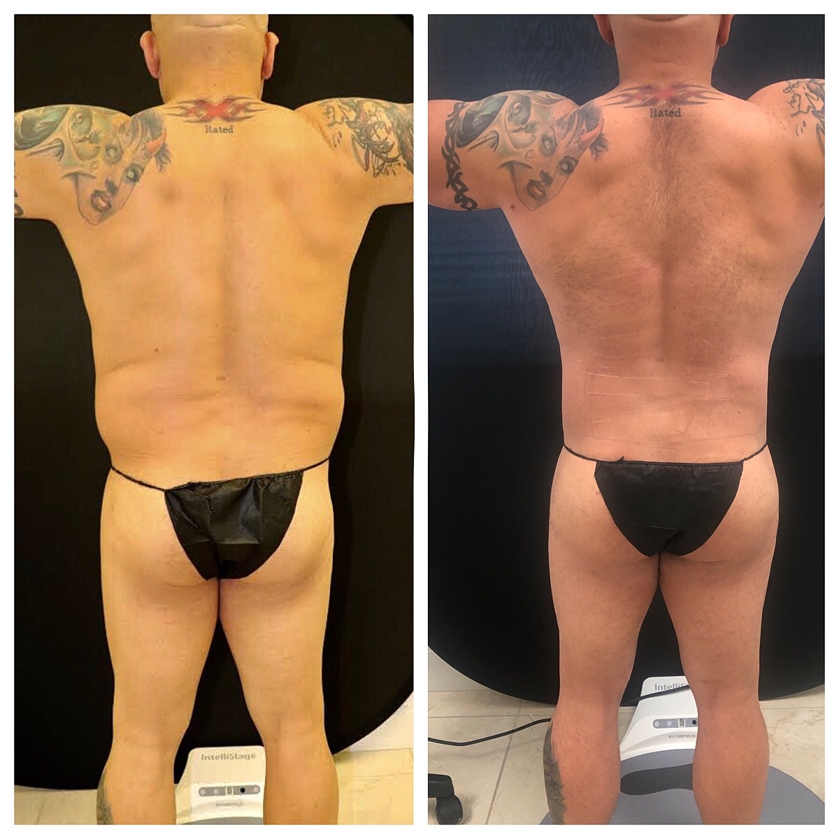 4d Vaser Liposuction For Men Before & After