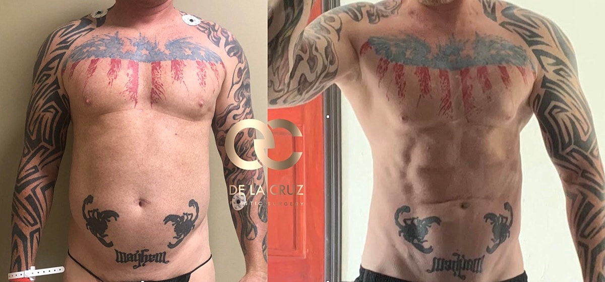 4d Vaser Liposuction For Men Before & After