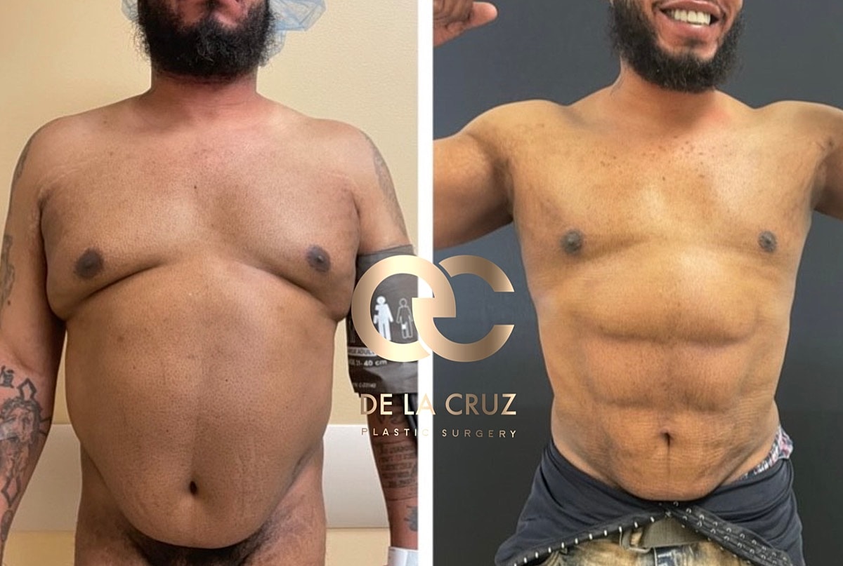 4d Vaser Liposuction For Men Before & After