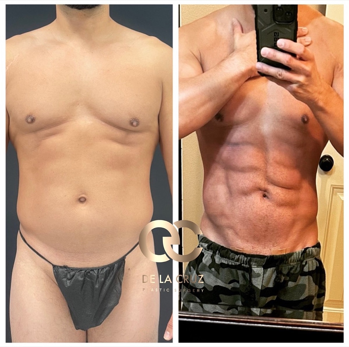 4d Vaser Liposuction For Men Before & After