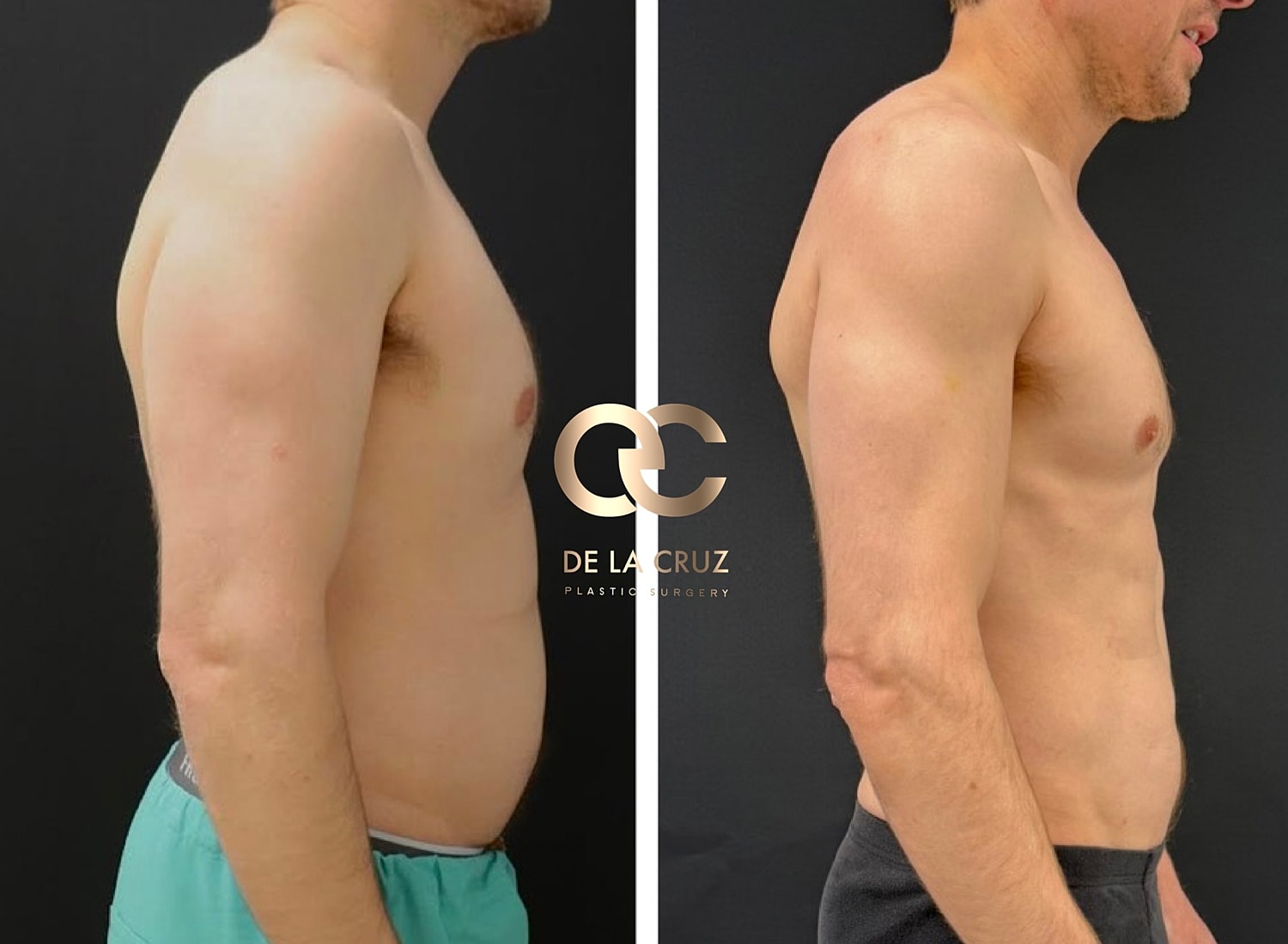 Before and after plastic surgery side profiles.