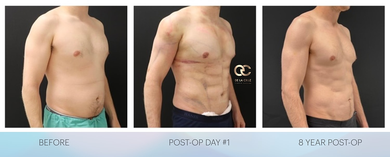 Before and after results high definition liposuction in men