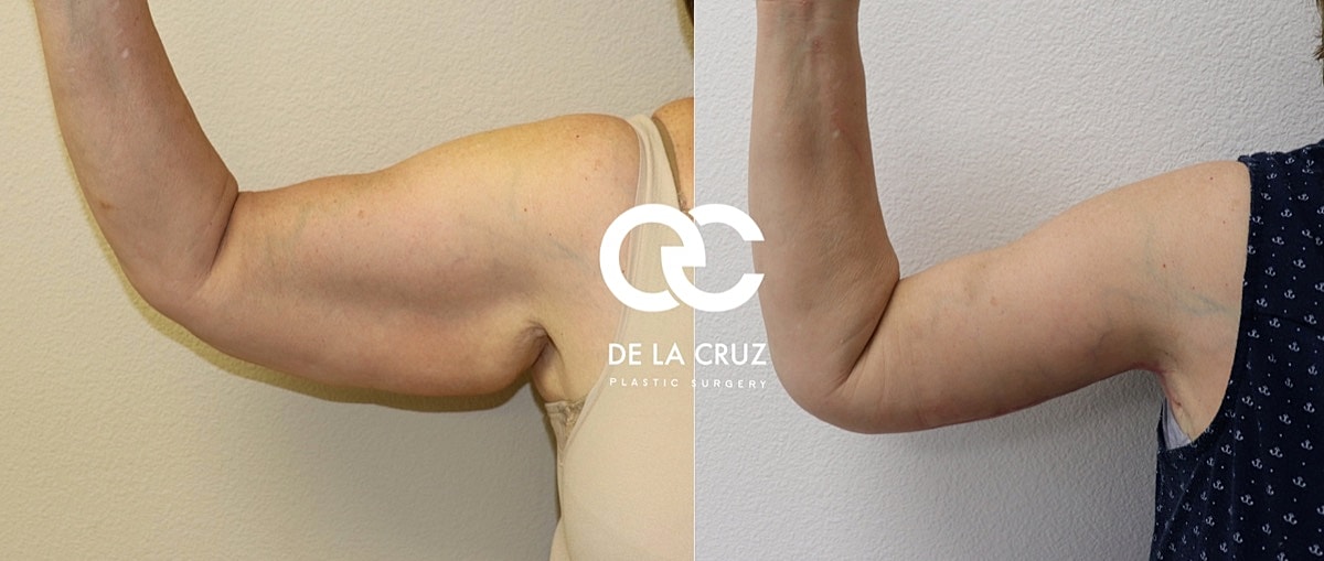 Brachioplasty Before & After