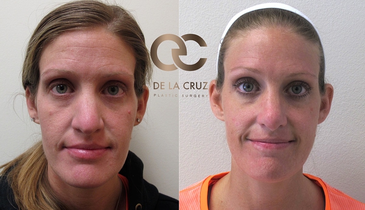 Rhinoplasty Before & After