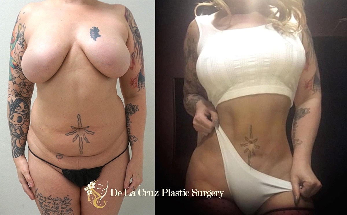 4D Vaser Liposuction Before & After