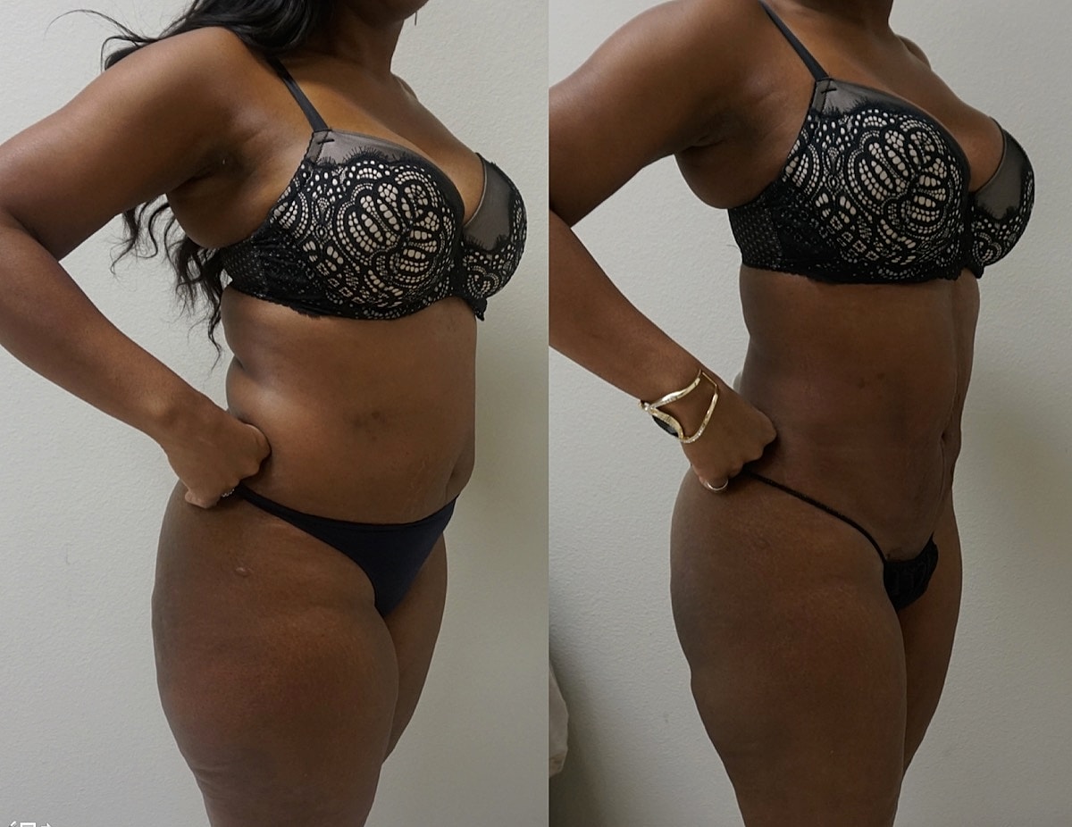 4d Vaser Liposuction Before & After