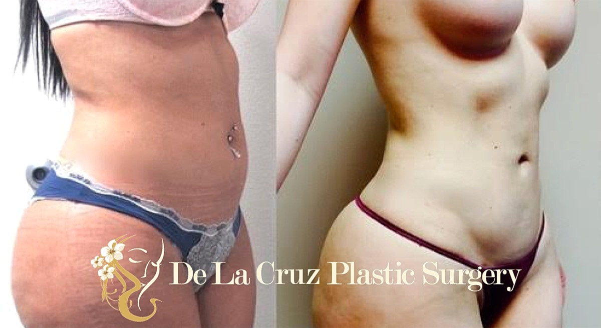 4d Vaser Liposuction Before & After