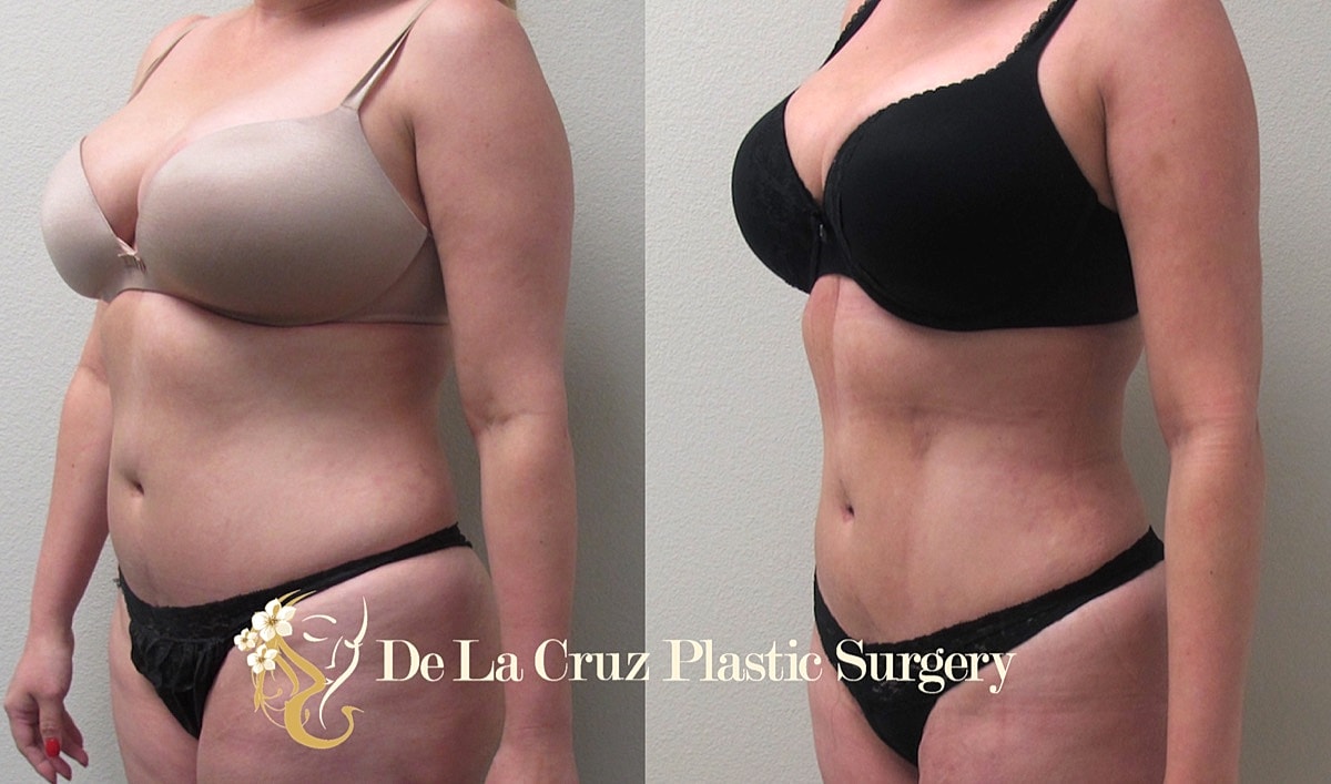 4d Vaser Liposuction Before & After