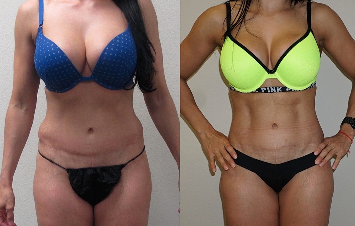 4d Vaser Liposuction Before & After
