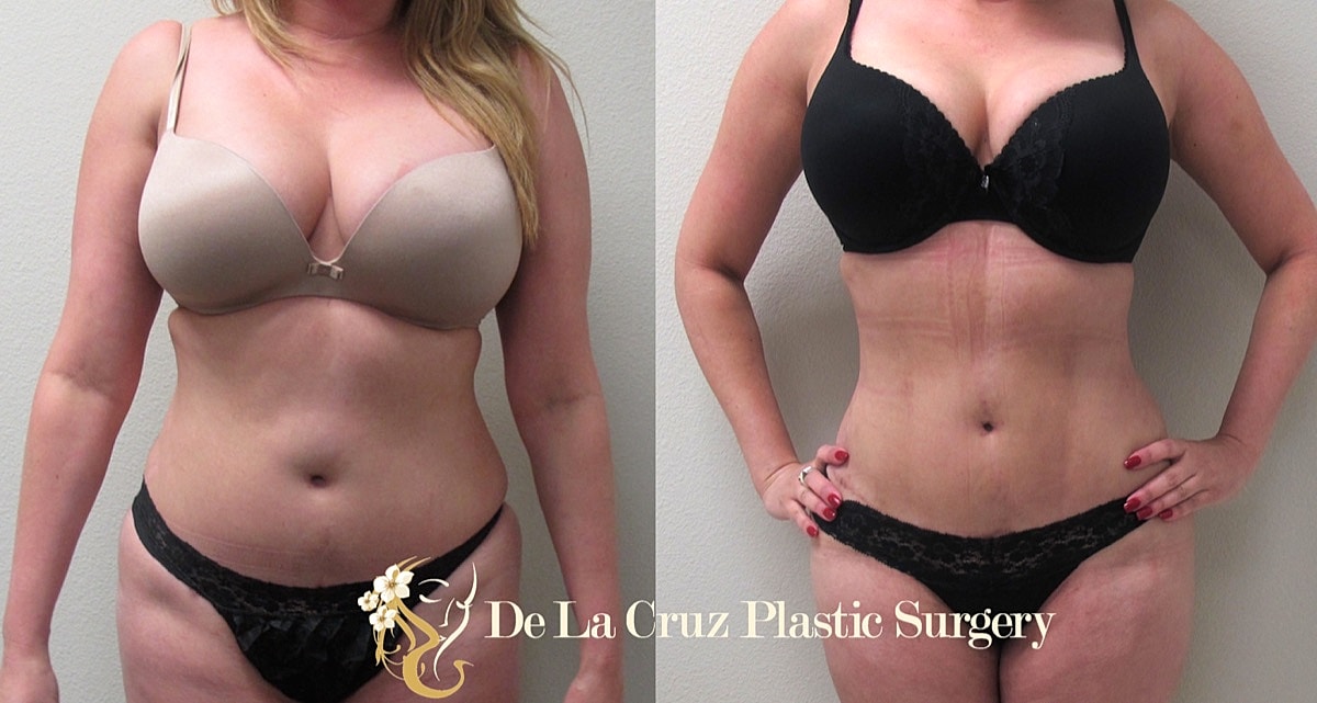 4d Vaser Liposuction Before & After