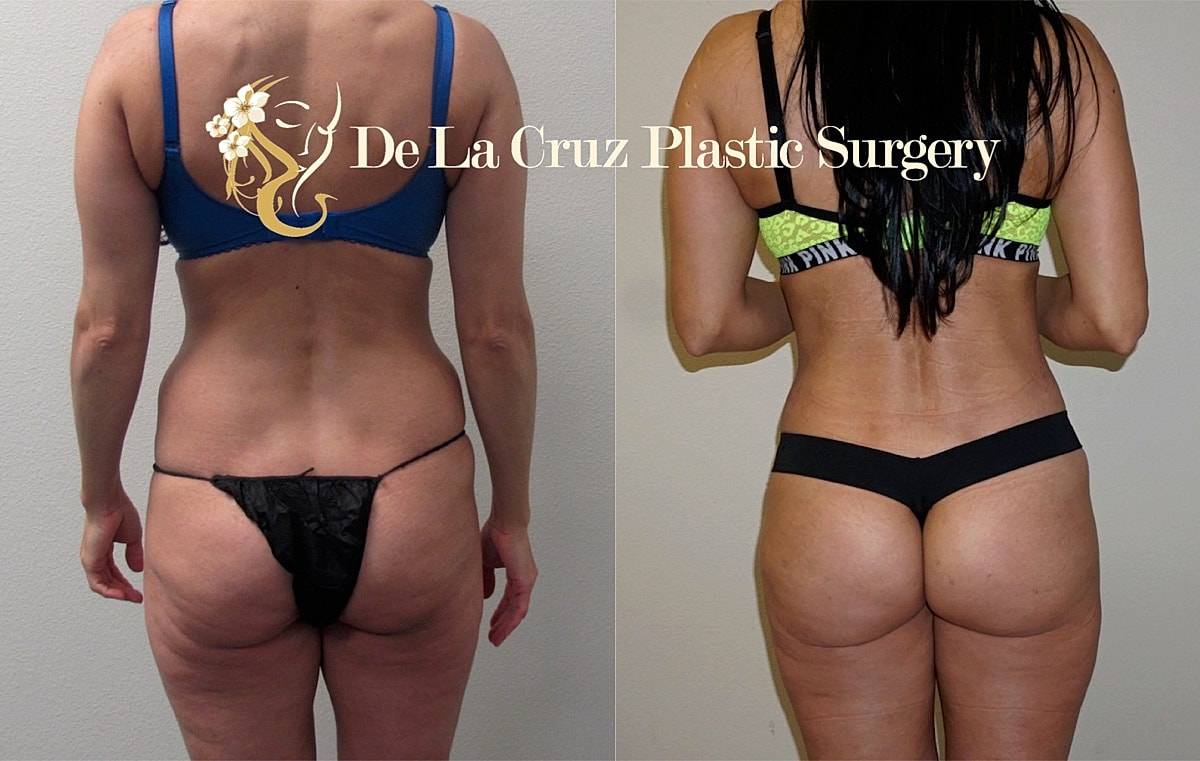 4d Vaser Liposuction Before & After