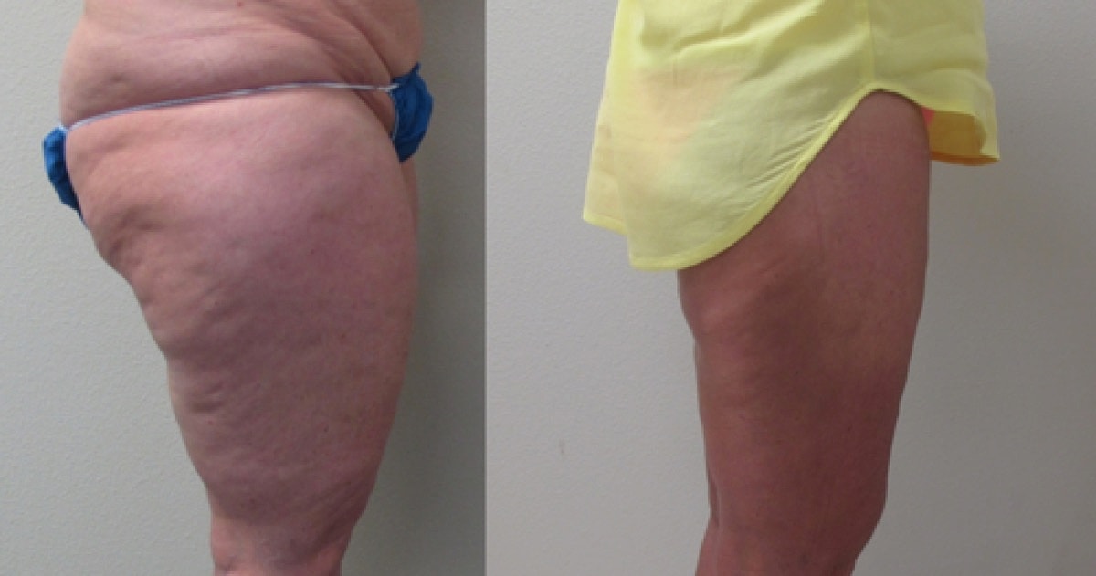 4d Vaser Liposuction Before & After