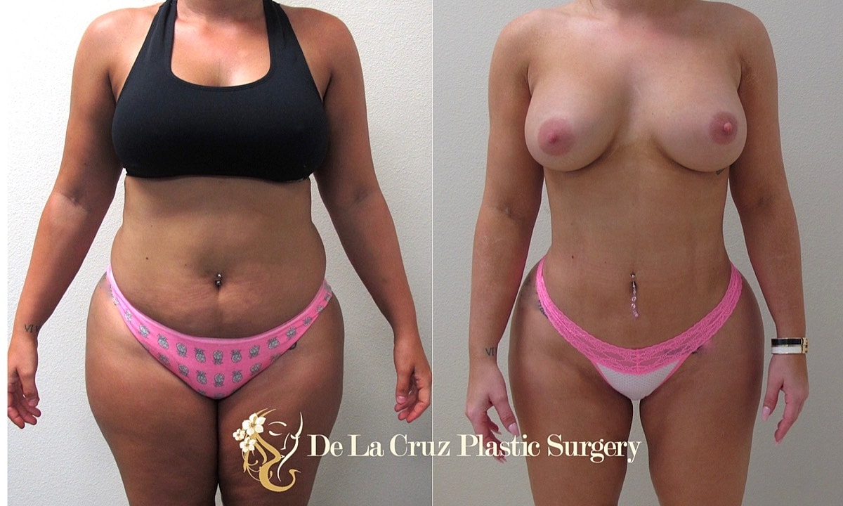4d Vaser Liposuction Before & After