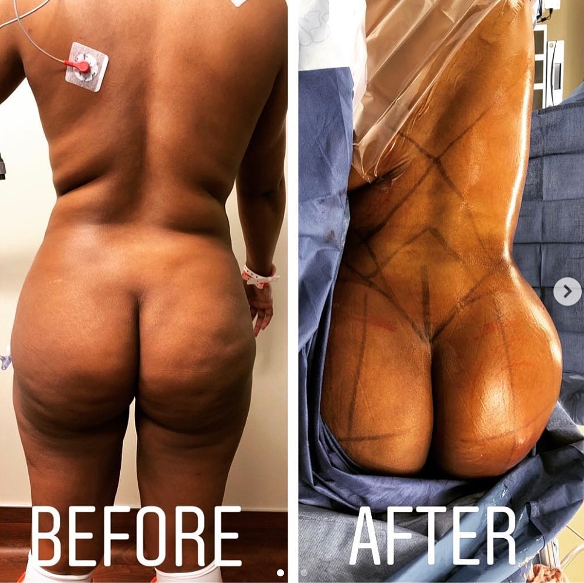 4d Vaser Liposuction Before & After