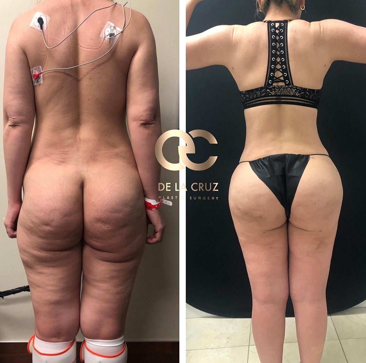 4d Vaser Liposuction Before & After