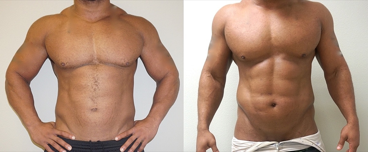 4d Vaser Liposuction Before & After