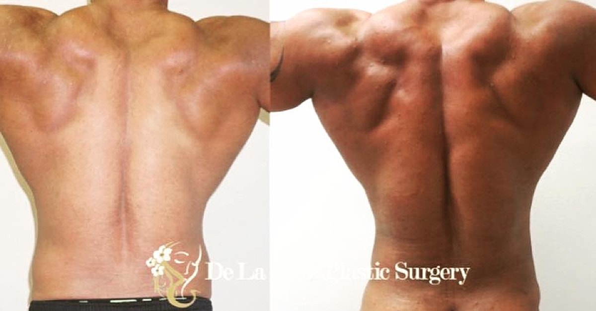 4d Vaser Liposuction Before & After