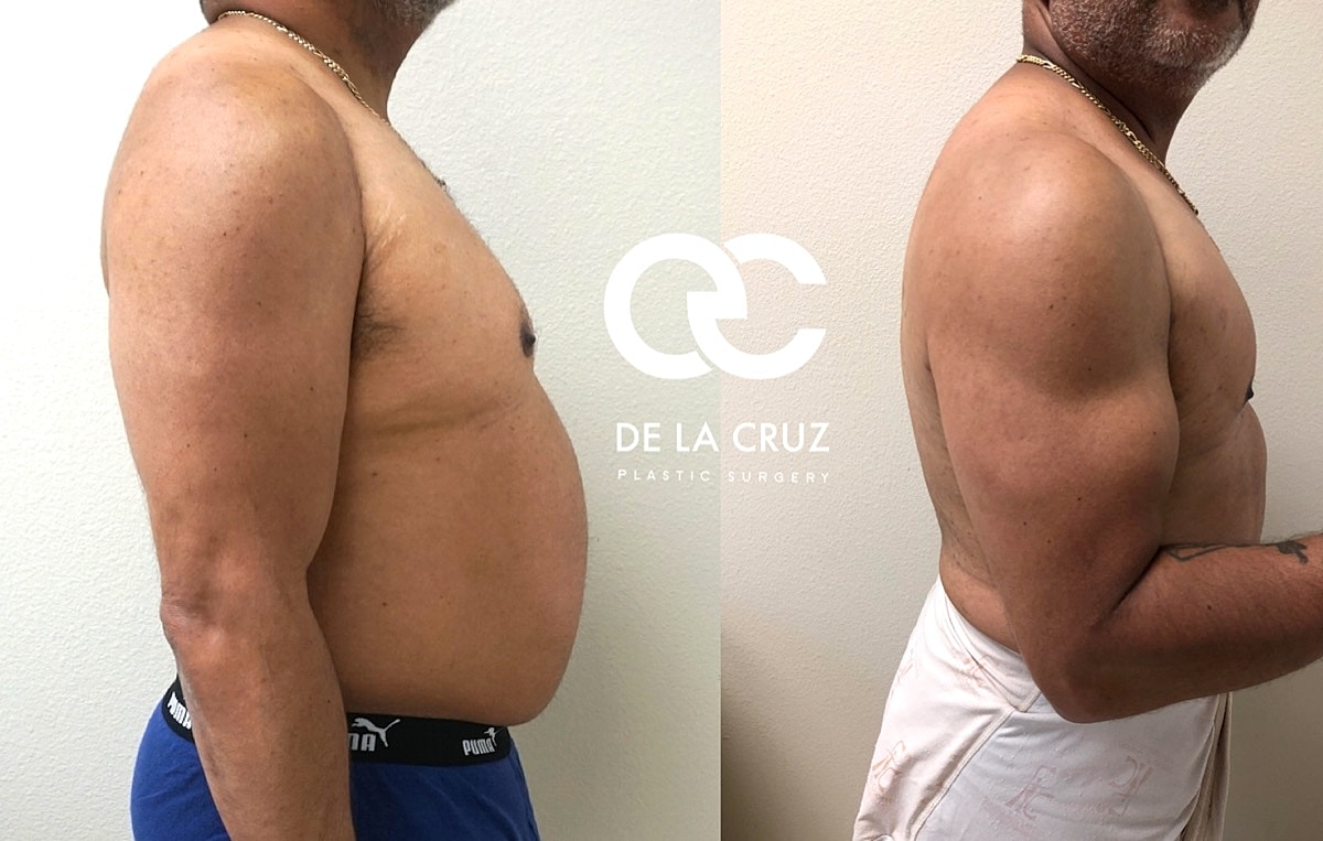 4d Vaser Liposuction Before & After