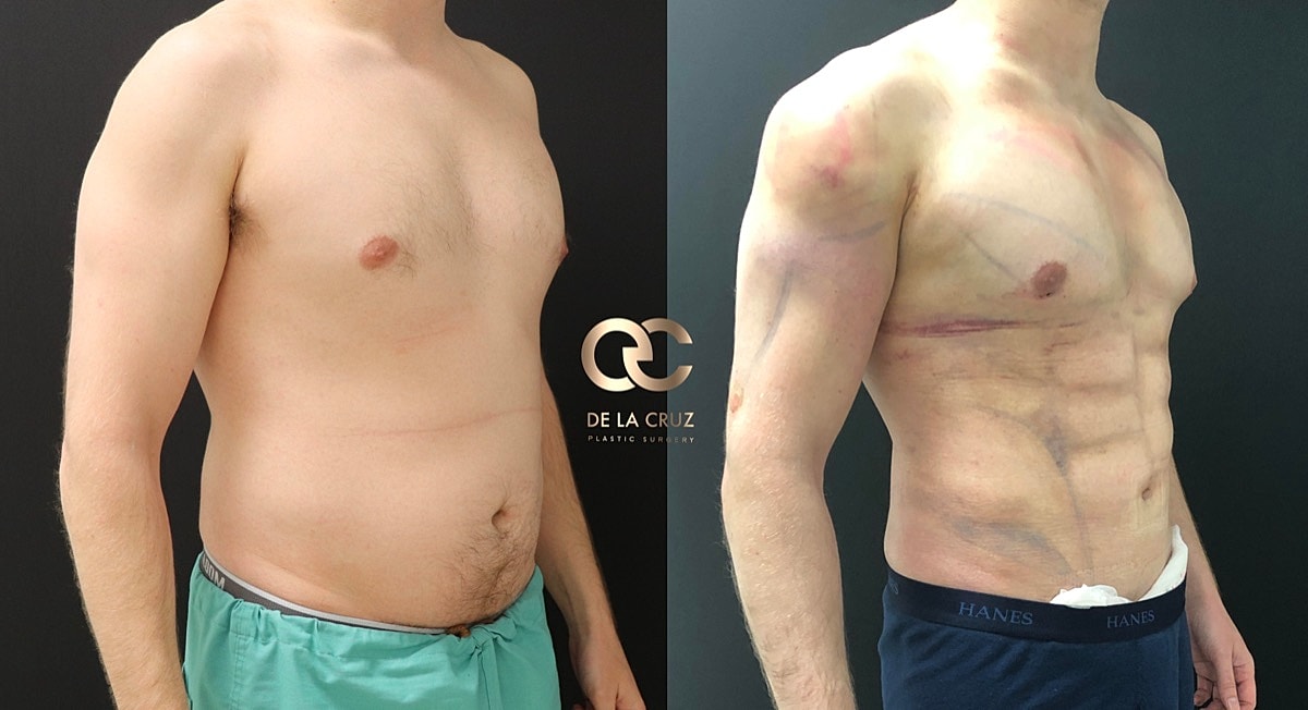 4d Vaser Liposuction Before & After