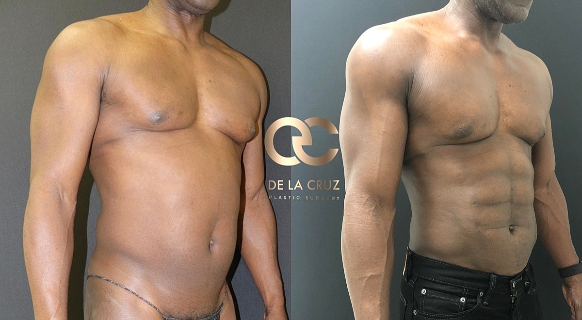 4d Vaser Liposuction Before & After
