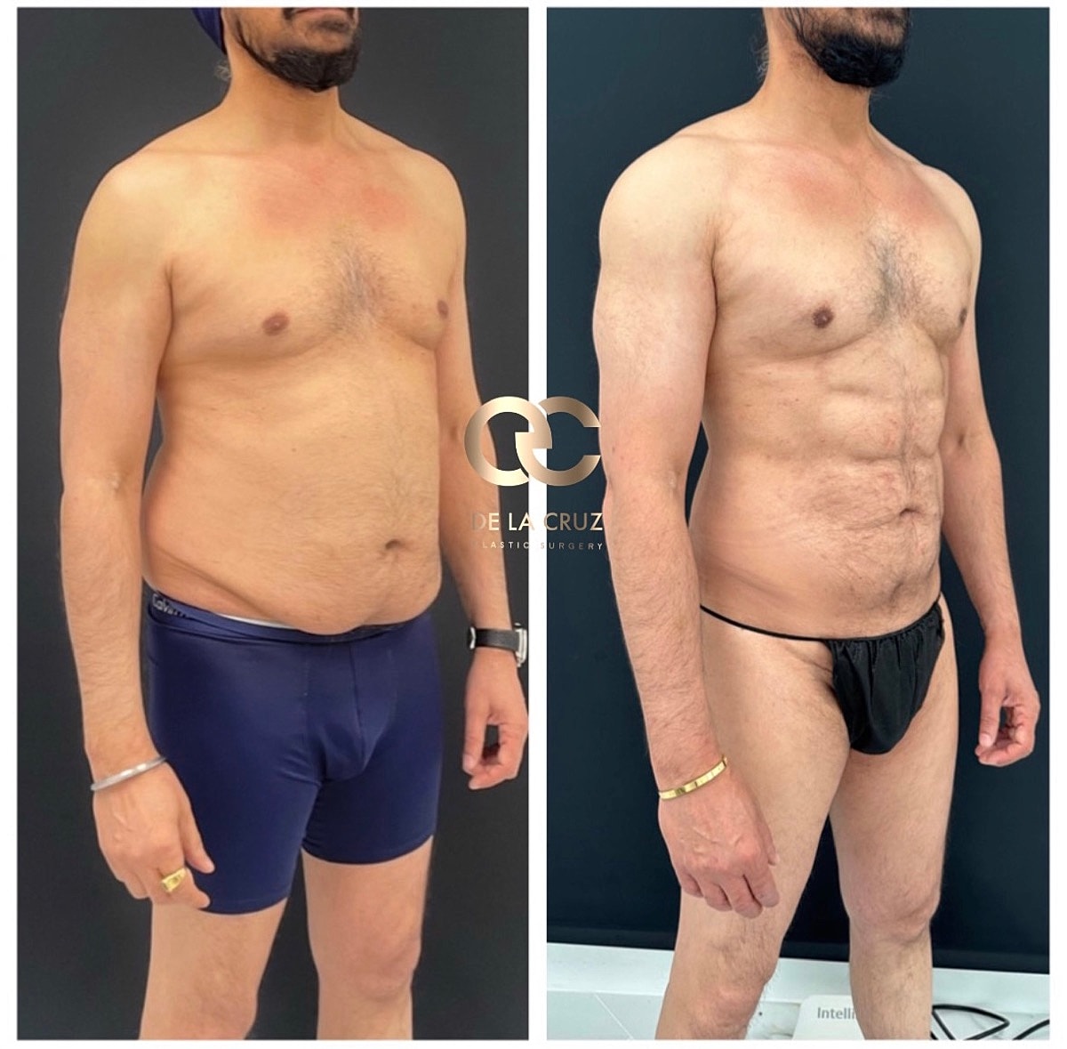 4d Vaser Liposuction Before & After