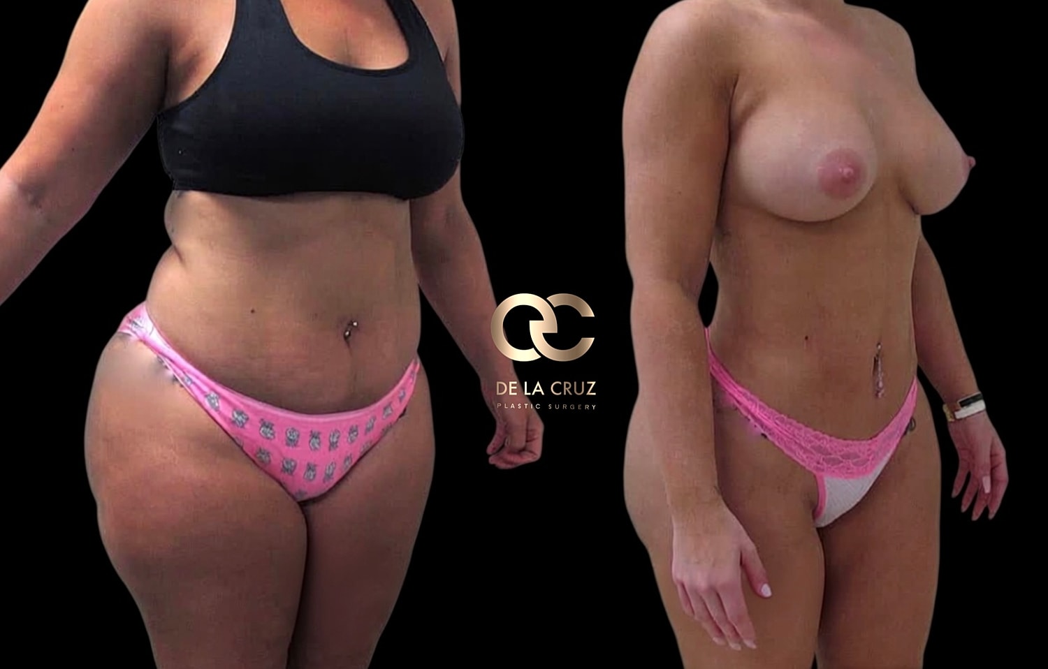Before and after plastic surgery transformation.