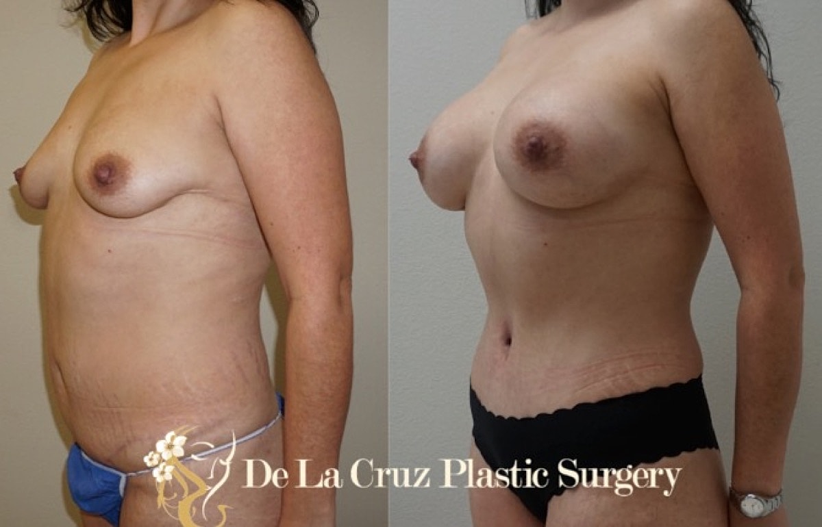 Houston tummy tuck results demonstrating abdominal muscle repair and contour refinement.