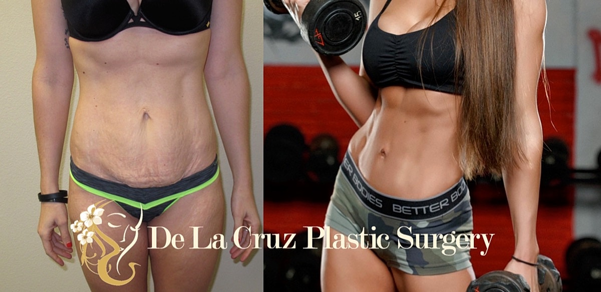 Abdominoplasty Before & After