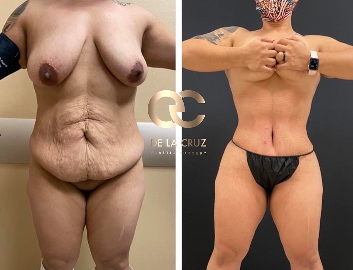 Abdominoplasty Houston
