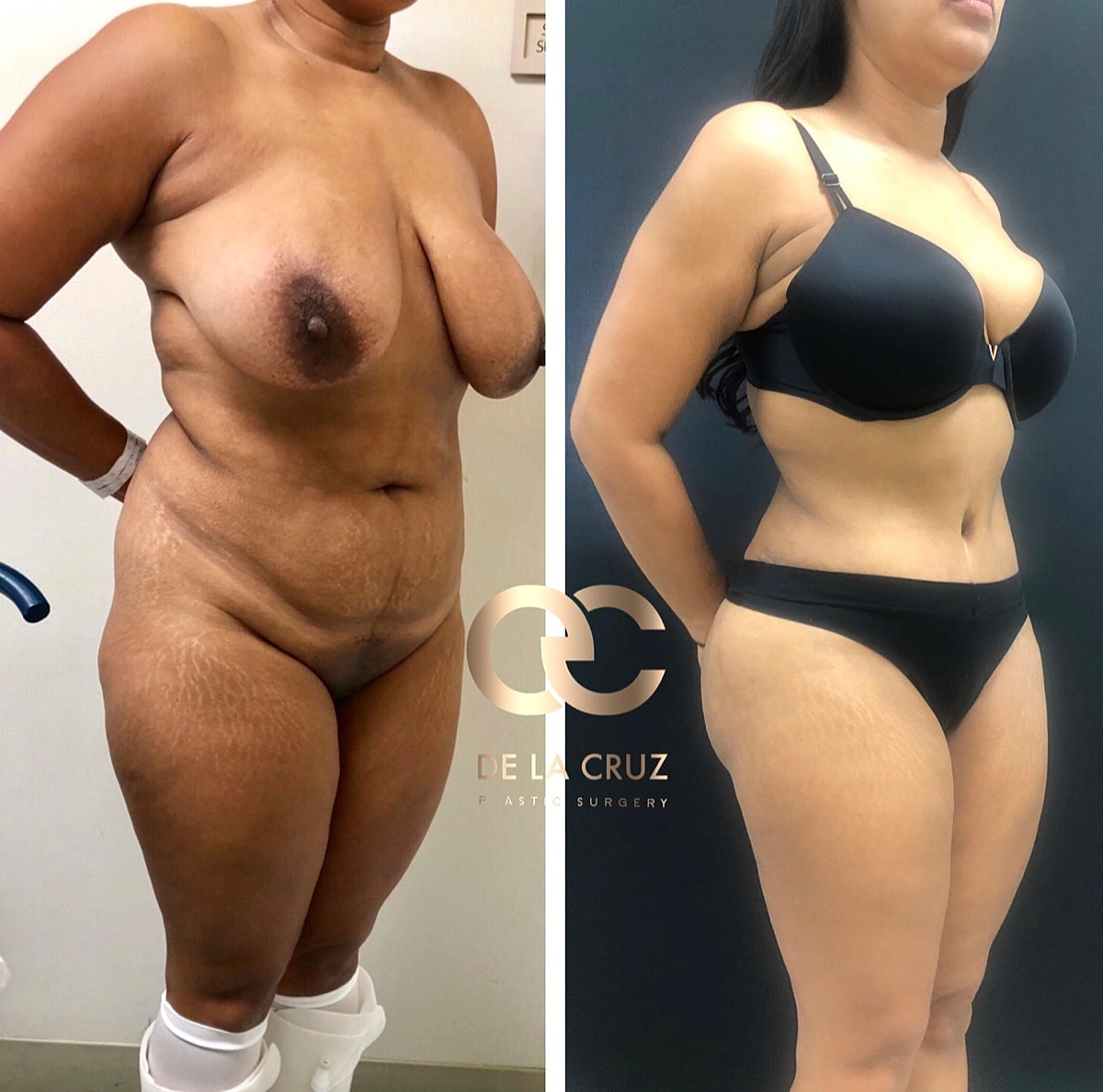 Abdominoplasty Before & After